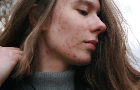 Cura del viso: come prendersi cura delle cicatrici da acne