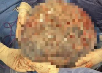 Rimossa massa ovarica di 50 cm nell’addome: l’intervento eccezionale all’ospedale di Matera