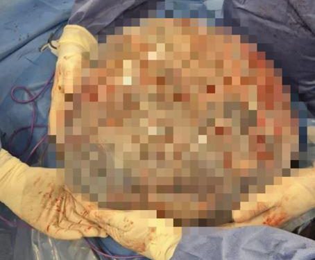 Rimossa massa ovarica di 50 cm nell’addome: l’intervento eccezionale all’ospedale di Matera